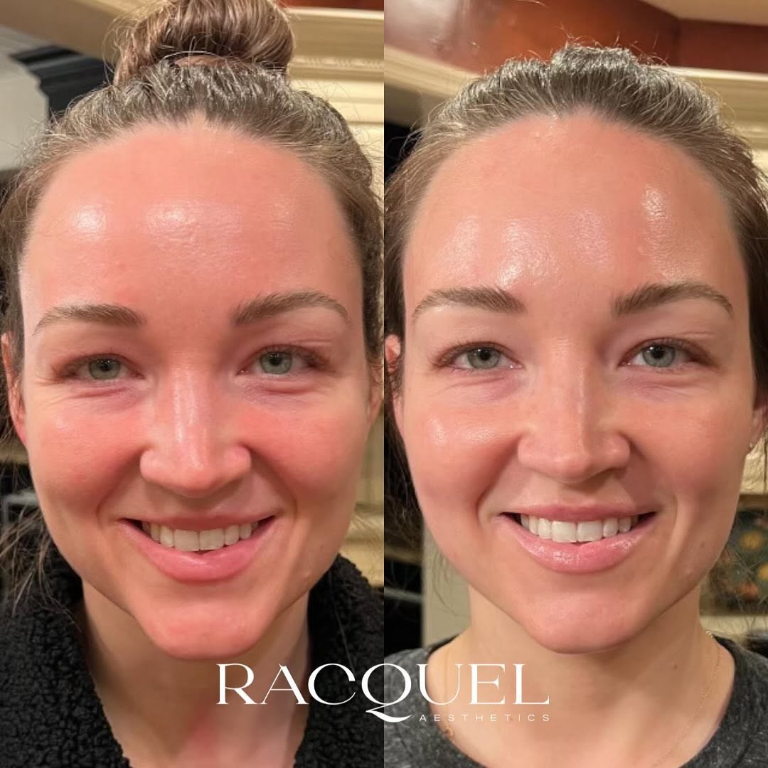 Before and after patient results
