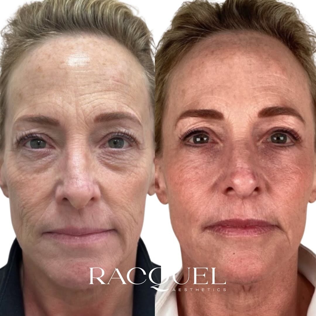 Reduced redness and even tone